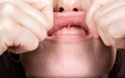 How Long Does A Frenectomy Take To Heal?