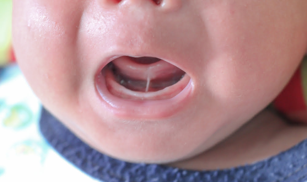 How To Tell If Your Baby Has a Lip Tie or a Tongue Tie