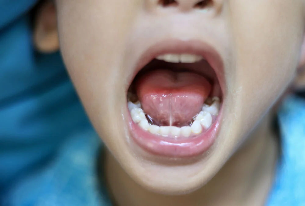 How To Care For Your Child After Tongue Tie Release?