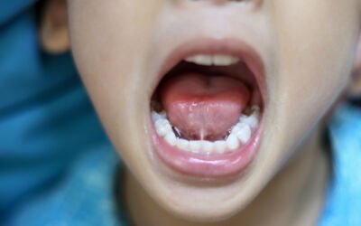 How To Care For Your Child After Tongue Tie Release?